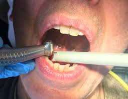 Dental-drill